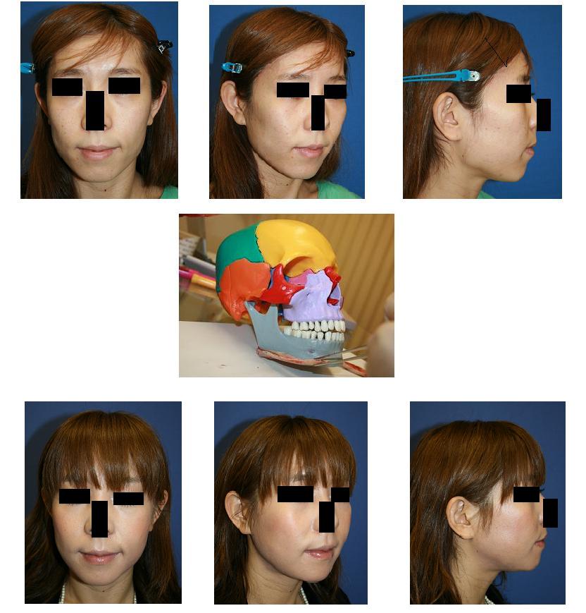 頬骨再構築法,エラ～顎先下顎骨骨きり術，術後３ヶ月_d0092965_035839.jpg