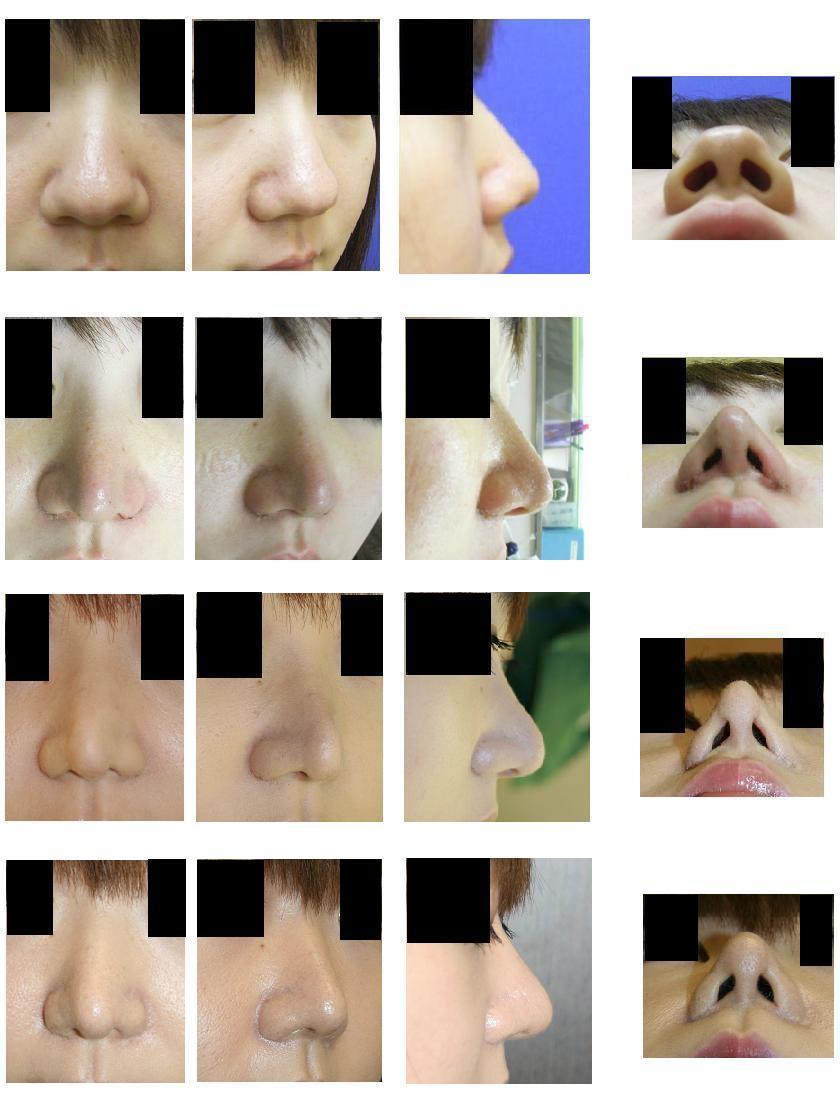 鼻尖縮小術（クローズ法）、小鼻縮小術（外側切除法）　術後１０ヶ月_d0092965_0503428.jpg