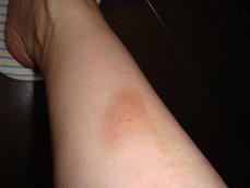 mosquito bites me！_f0046151_2003863.jpg
