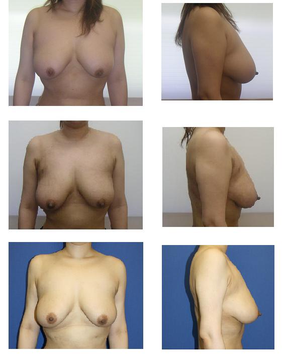 乳房部脂肪吸引（乳房縮小術）、背中脂肪吸引、上腕脂肪吸引_d0092965_1234558.jpg