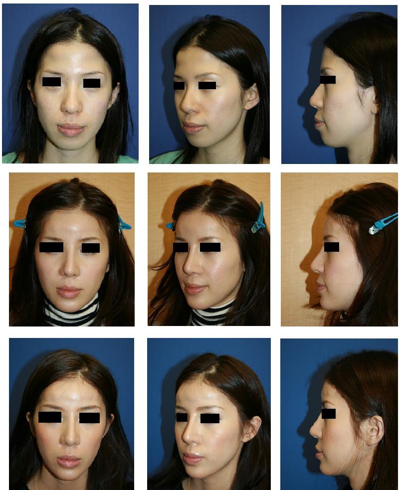 額形成術、鼻プロテーゼ、鼻尖縮小術、鼻翼基部プロテーゼ（ほうれい線プロテーゼ）、顎プロテーゼ 留置術_d0092965_2281616.jpg