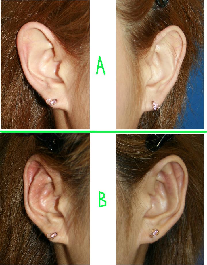 両耳たち耳修正術：クローズ法_d0092965_0431566.jpg