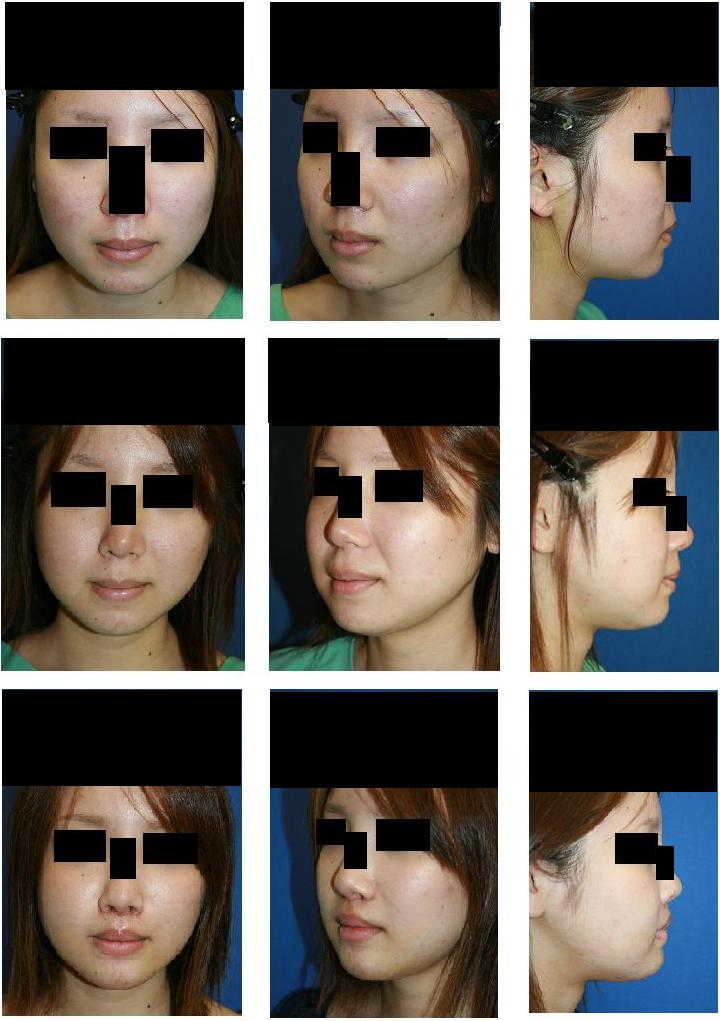 頬骨再構築法、エラ骨骨切り術、人中短縮術、顎プロテーゼ、鼻翼基部プロテーゼ_d0092965_23361666.jpg