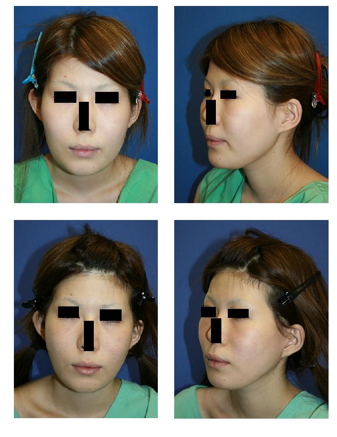 頬骨再構築法、ロアーリフト、頬、顎脂肪吸引_d0092965_23161295.jpg