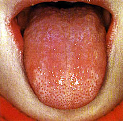 舌痛症　_e0097212_953345.jpg
