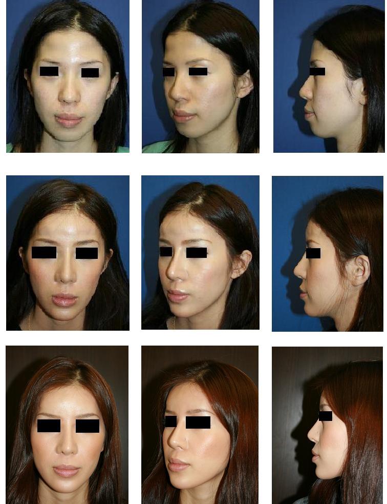 アパタイト額形成術、鼻プロテーゼ、鼻尖縮小術、ほうれい線プロテーゼ、顎プロテーゼ 留置術_d0092965_1224179.jpg