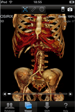 OsiriX for iPhoneーやっと登場しました！_a0055913_064159.gif