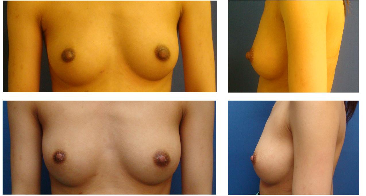 他院修正乳頭縮小術_d0092965_23154213.jpg