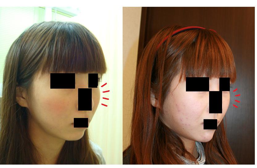 頬骨再構築法術後5か月_d0092965_1224939.jpg