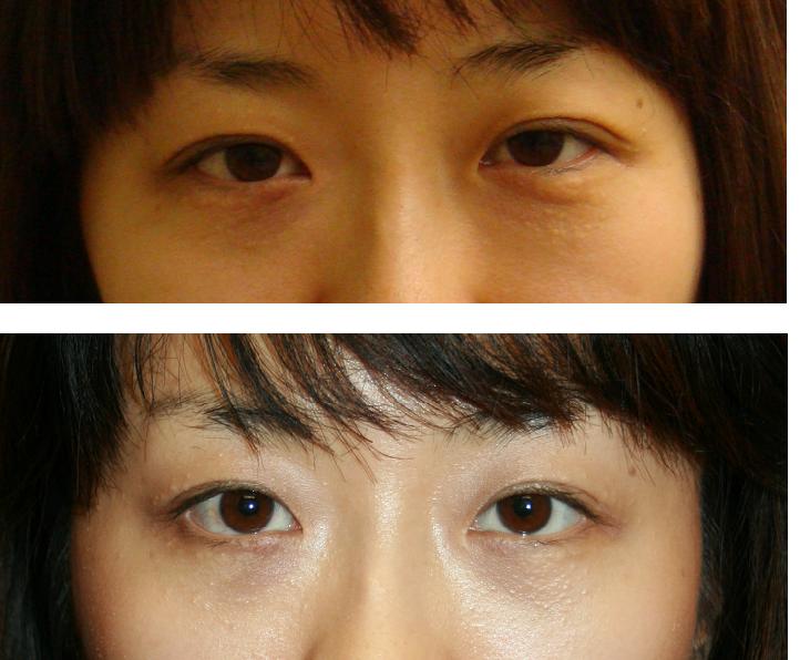 下眼瞼脱脂および脂肪移植_d0092965_0484412.jpg