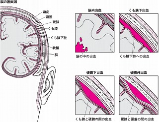 脳出血後遺症_e0097212_10591353.jpg