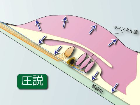 耳鼻科医のお絵かき〜内リンパ水腫〜_e0084756_2024291.gif