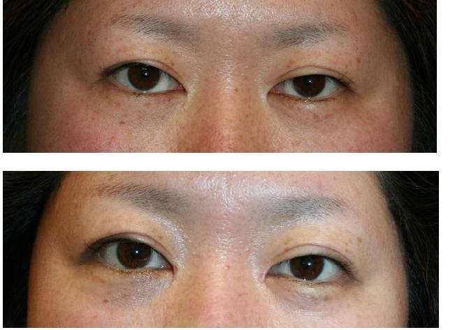 他院目頭切開術後修正術、三白眼修正術_d0092965_1173880.jpg