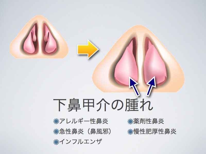 下鼻甲介の腫れ_e0084756_1352137.jpg