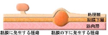 癌の手術の必要性は?_e0097212_0223978.jpg