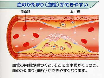 再発性脳梗塞での複視_e0097212_14983.jpg
