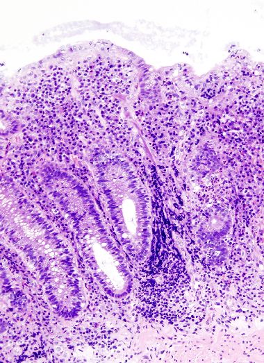 虫垂炎・腸間膜リンパ節炎による20歳以前の虫垂切除は、潰瘍性大腸炎発症を減らす_e0156318_19553861.jpg