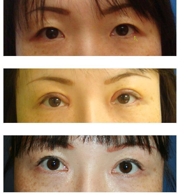 目頭切開術、つり目形成術、二重切開形成術、 左下眼瞼縁凸部修正_d0092965_22514814.jpg