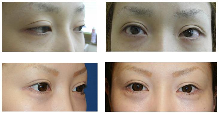 涙袋形成術(プロテーゼ留置術)、下眼瞼脱脂術 術後約2年_d0092965_1392820.jpg