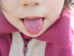 地図状舌 Map Like Tongue Syndrome Happy Life With A New Addition
