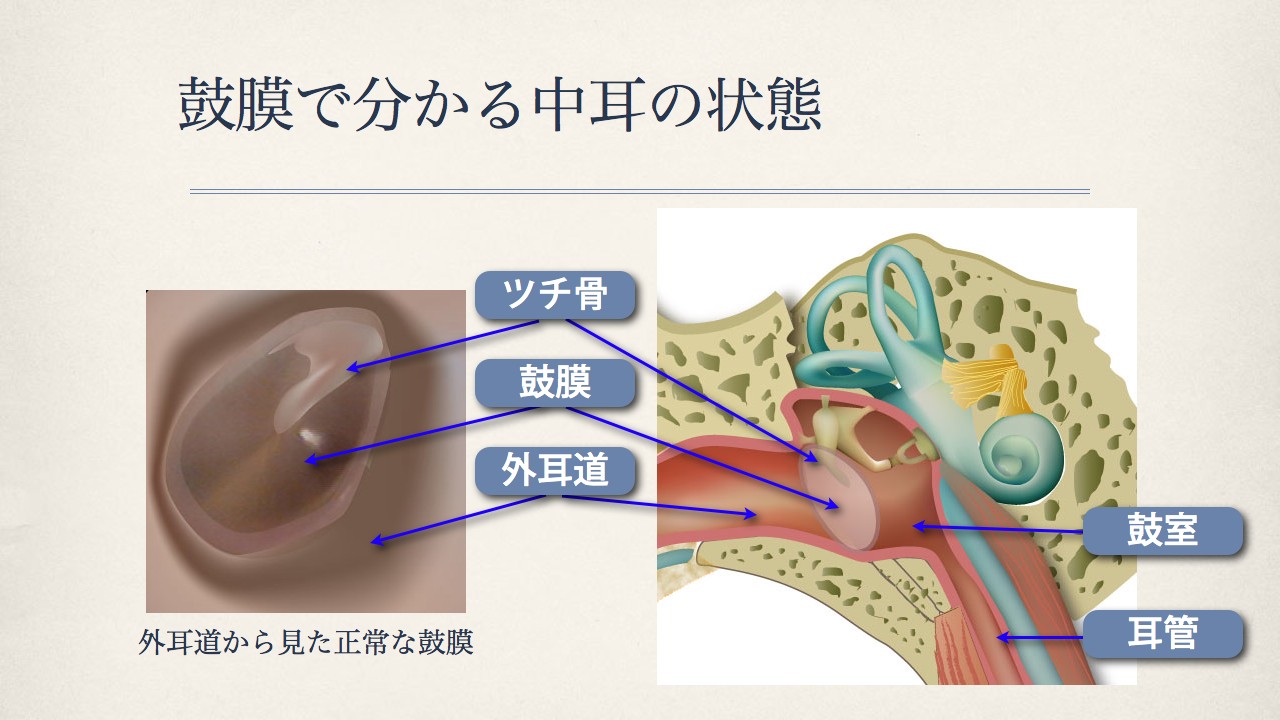 鼓膜で分かる中耳の状態(正常な鼓膜、急性中耳炎の時の鼓膜)_e0084756_8262892.jpg