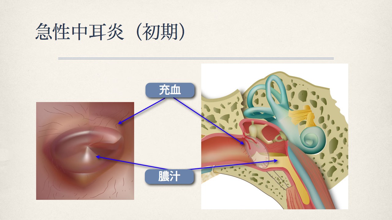 鼓膜で分かる中耳の状態(正常な鼓膜、急性中耳炎の時の鼓膜)_e0084756_8343756.jpg
