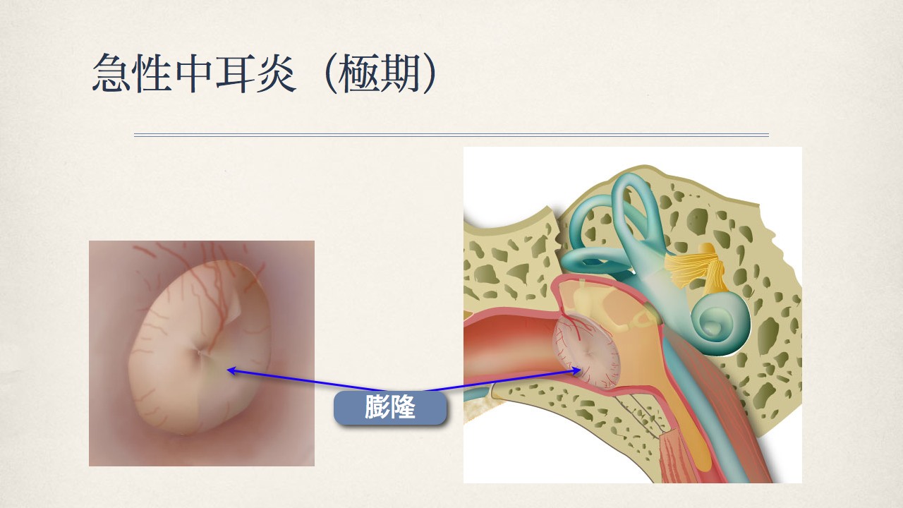 鼓膜で分かる中耳の状態(正常な鼓膜、急性中耳炎の時の鼓膜)_e0084756_8344988.jpg