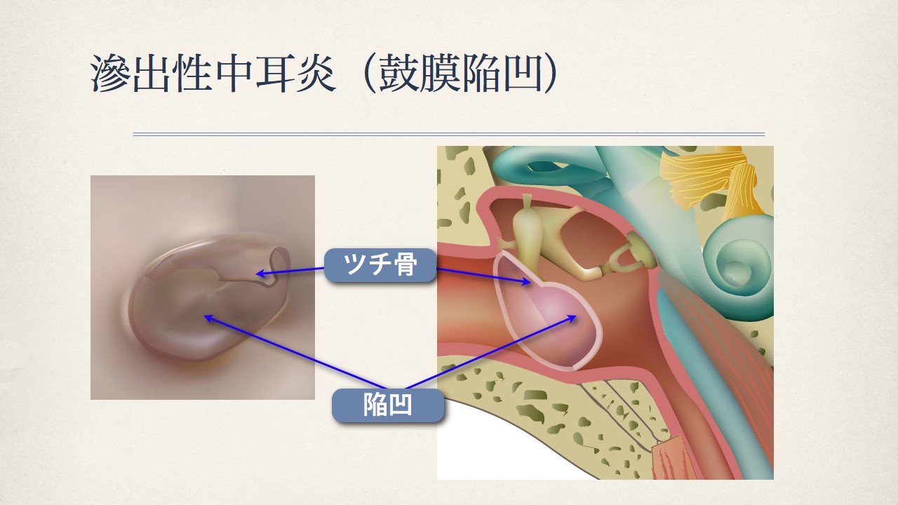 鼓膜で分かる中耳の状態(滲出性中耳炎の鼓膜)_e0084756_18192680.jpg
