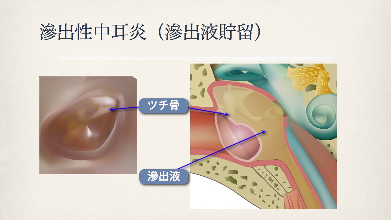 鼓膜で分かる中耳の状態(滲出性中耳炎の鼓膜)_e0084756_18193715.jpg