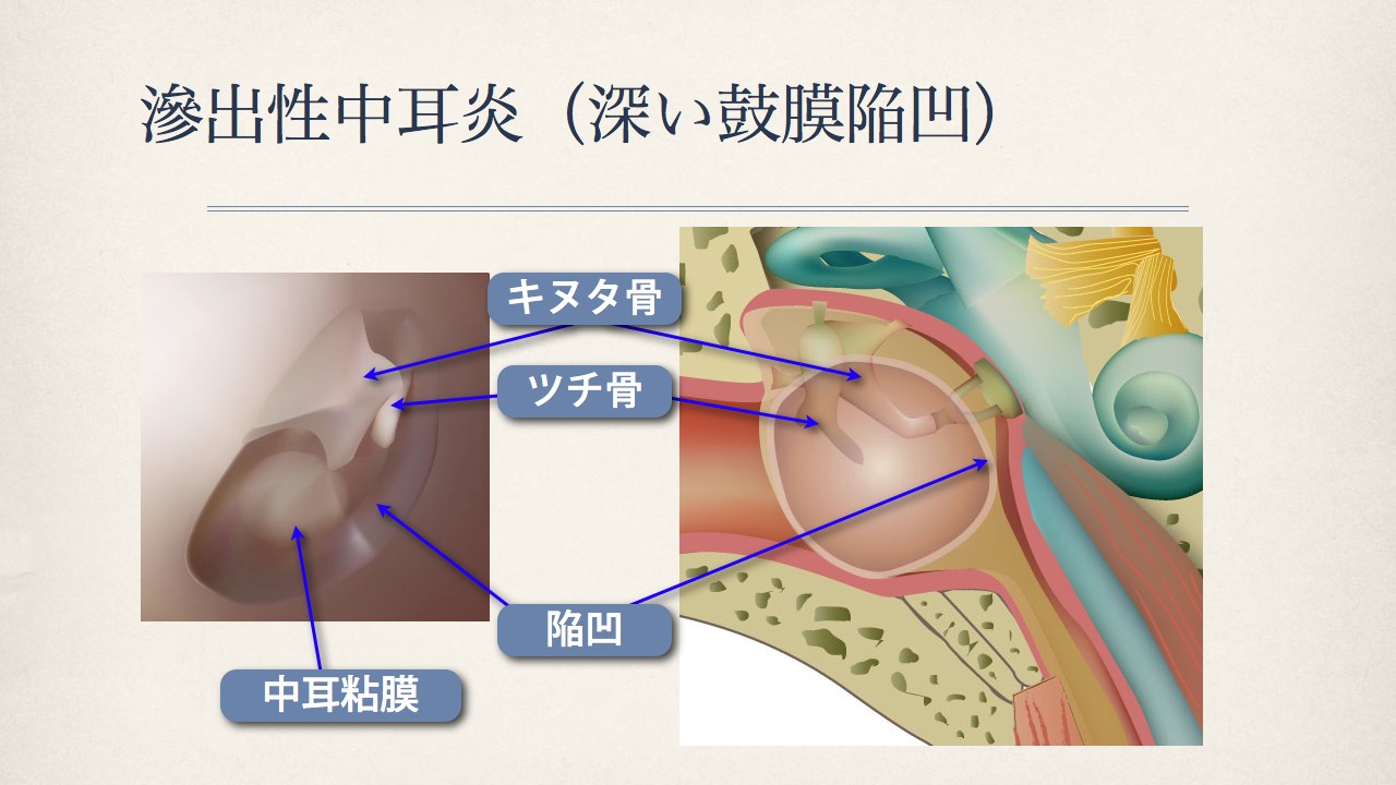 鼓膜で分かる中耳の状態(滲出性中耳炎の鼓膜)_e0084756_18195768.jpg