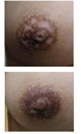 美容形成外科後遺症: 乳輪脱色(レーザー)_d0092965_15134077.jpg