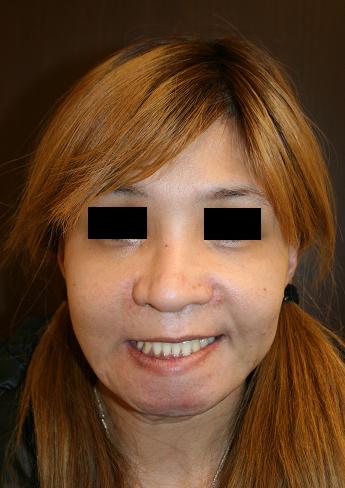 美容形成外科後遺症：ルフォーⅠ型骨切り術、鼻中隔延長術_d0092965_0372361.jpg