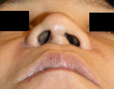 美容形成外科後遺症：ルフォーⅠ型骨切り術、鼻中隔延長術_d0092965_03854.jpg