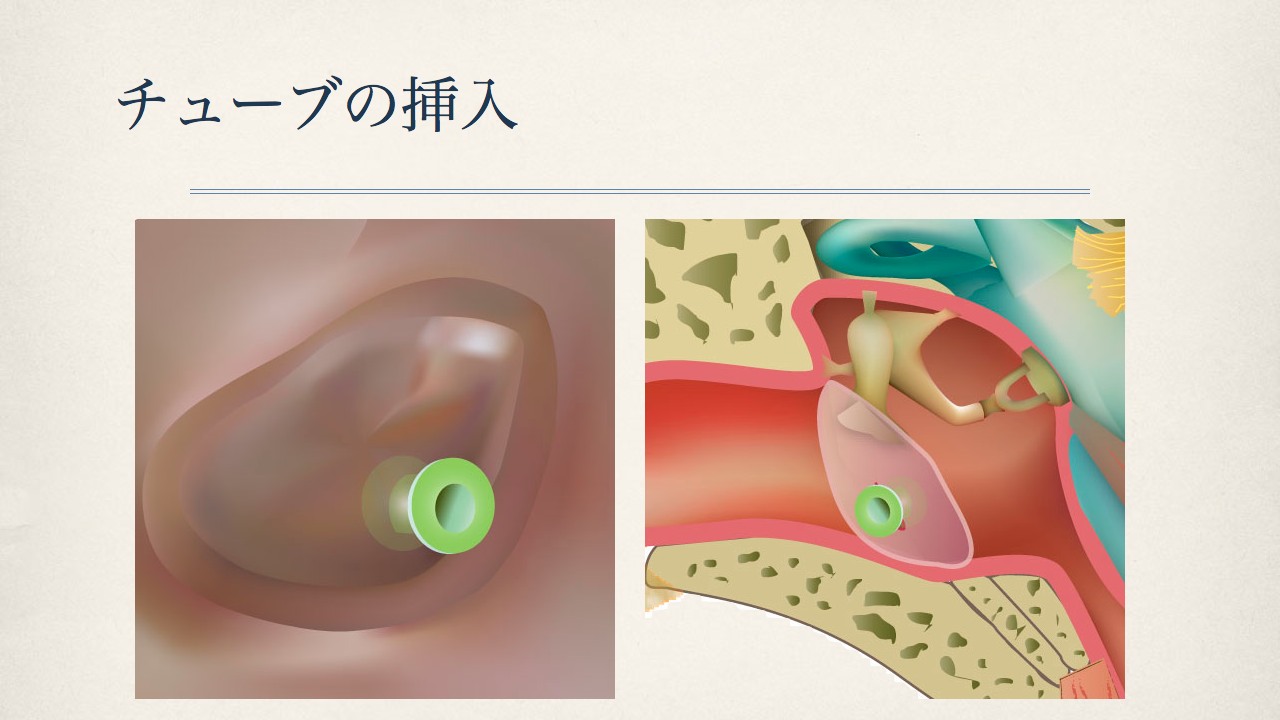 鼓膜チューブ留置術（いわゆるチュービング）について_e0084756_21402529.jpg