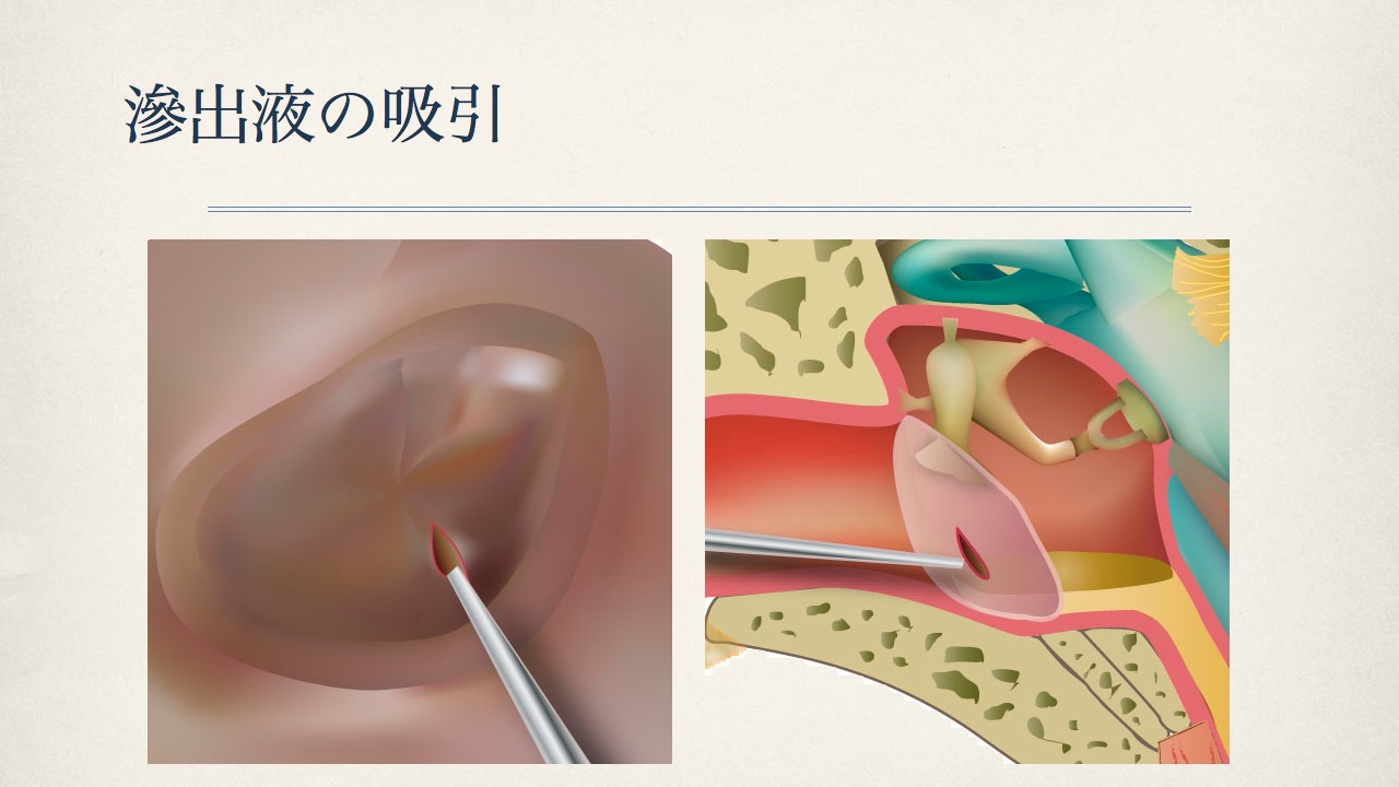 鼓膜チューブ留置術（いわゆるチュービング）について_e0084756_2140857.jpg