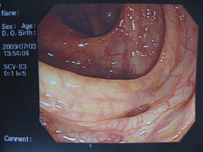 ●大腸内視鏡写真公開w 結果は白ですが・・・_a0033733_13125428.jpg