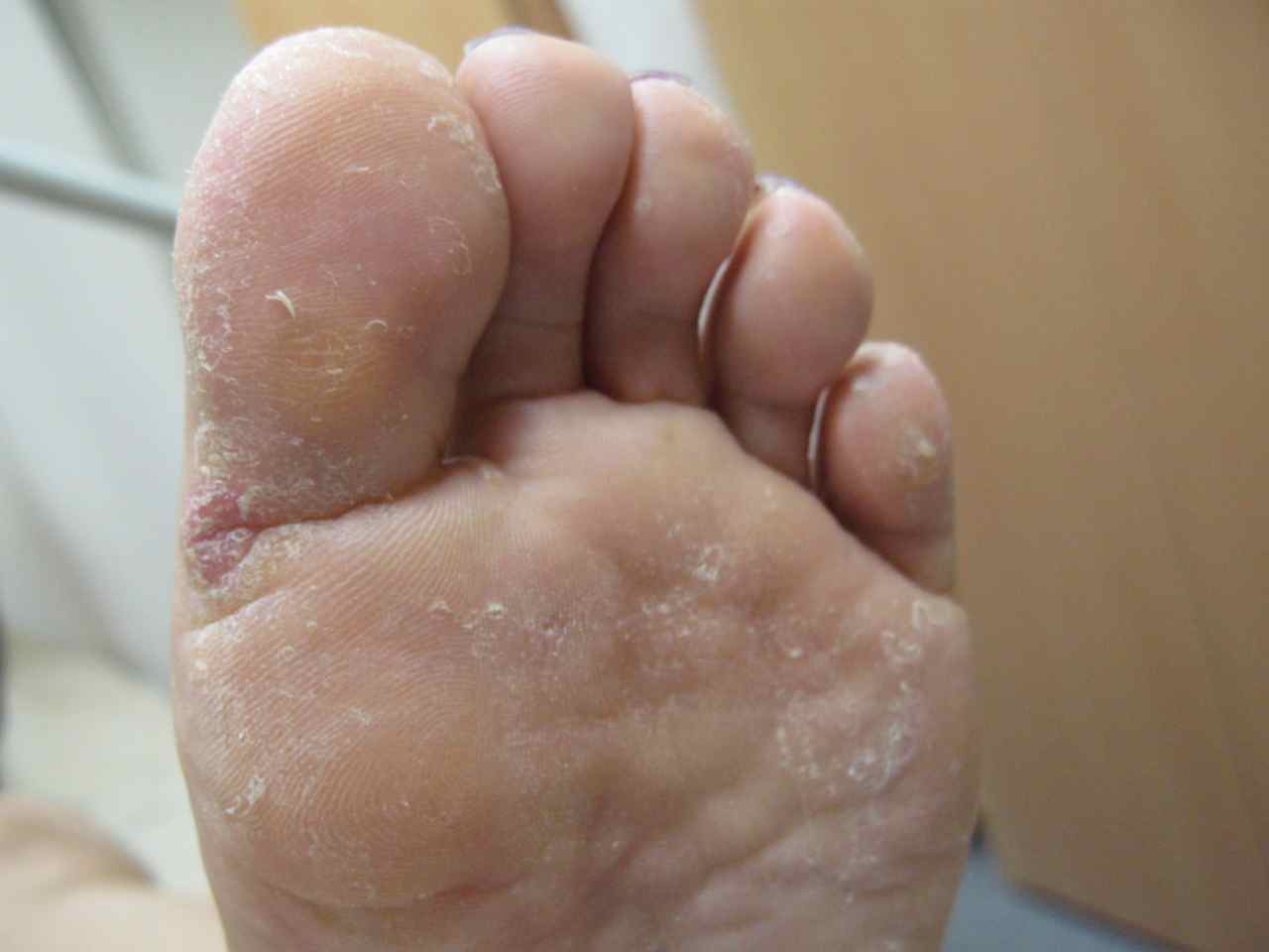 脱皮 林足研究所 足 外反母趾 修正 日常の日記 脱皮 林足研究所 足 外反母趾 修正 日常の日記