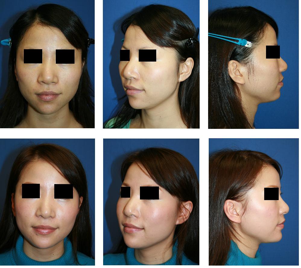 鼻根縮小術、小鼻縮小術、顎プロテーゼ入れ換え術、頬骨前方削り術_d0092965_143041.jpg