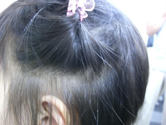 しらみ 頭虱 卵 の写真を紹介します 薬に頼らない頭じらみ退治法 しらみ 頭虱 卵 の写真を紹介します 薬に頼らない頭じらみ退治法