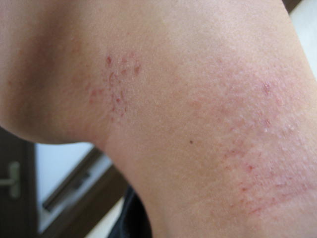 方 治し 汗疹 の 皮膚カビが汗疹(あせも)とアトピーの原因？大人の治し方や予防対策