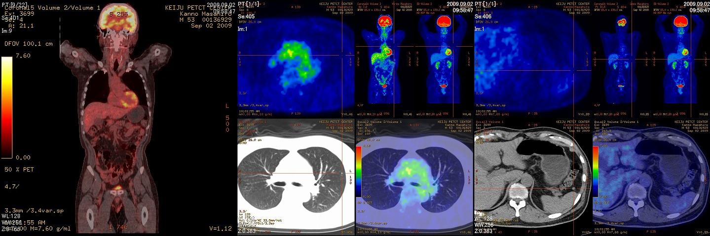 PET-CT健診体験_b0115629_13404666.jpg