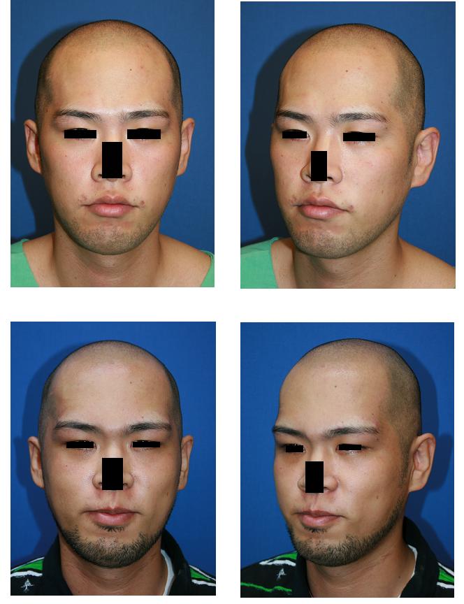 頬骨再構築法 眉骨形成術 美容外科医のモノローグ