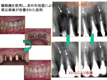 最新の根管治療！外科処置することなく改善(顕微鏡歯科治療）_e0163073_23444129.jpg