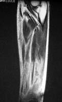 続コレステロールの薬(検査が正常でも筋損傷)_e0097212_12363191.jpg