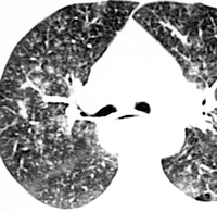 びまん性嚥下性細気管支炎Diffuse aspiration bronchiolitis (DAB)_e0156318_23435431.gif