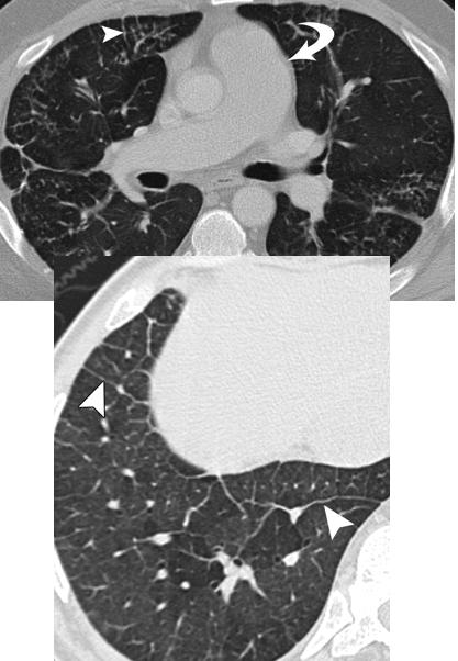 pulmonary veno-occlusive disease（PVOD）_e0156318_13255717.jpg
