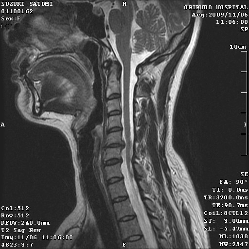 頸椎mri ラパスでtecate