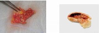 TIA(一過性脳虚血発作)10年で60%が死亡_e0097212_8391124.jpg