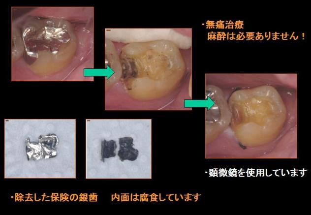 麻酔なしの無痛虫歯治療！_e0163073_025323.jpg