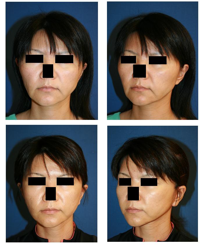 頬骨再構築、フェイスリフト、こめかみリフト、ほうれい部脂肪吸引 (同時手術）　術後４か月_d0092965_1822253.jpg